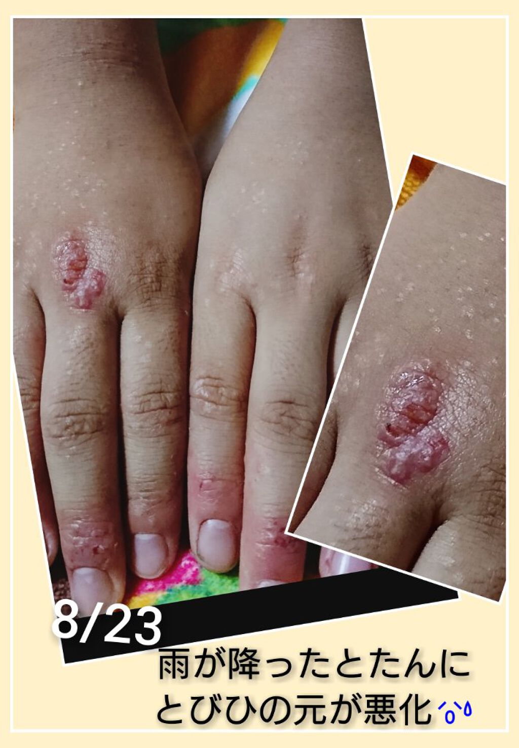 ❥ ❥ ❥ ru-ru-❥ ❥ ❥ on LIPS 「💥子供のとびひ💥ん…………せっかくいい感じだったのに😰💦雨が降..」(1枚目)