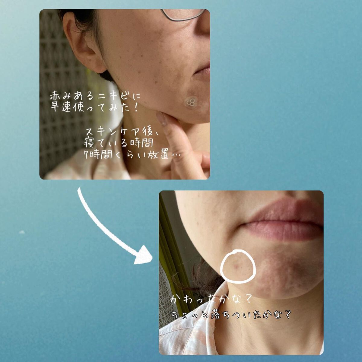 ACマグネシウムパッチ ミニ/スノーツープラス/にきびパッチを使ったクチコミ(3枚目)