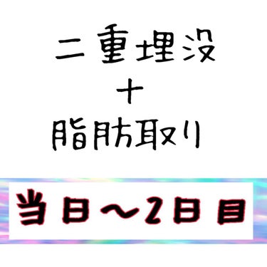 先日二重埋没と瞼の脂肪取りをしました!

そちらの経過及び過ごし方です🙏
経過は写真をご覧下さい!
目尻側の黒い糸は
脂肪取りをした部分を縫っているため飛び出ています。
1週間後抜糸です。


術日を０