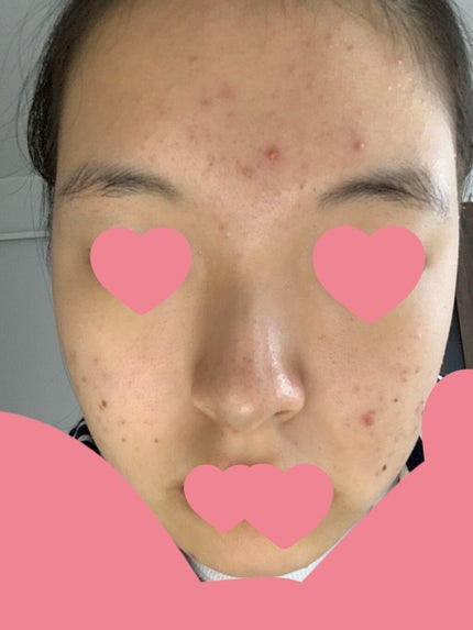 ペアアクネクリームW(医薬品)/ペア/その他を使ったクチコミ(4枚目)