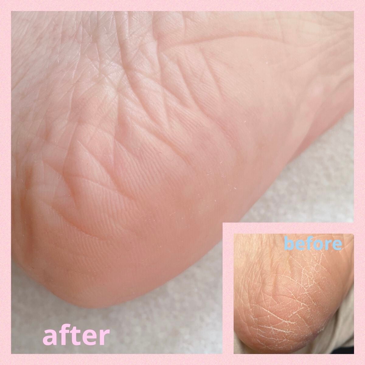 イージーパックDP60分タイプ/ベビーフット/レッグ・フットケアを使ったクチコミ(6枚目)