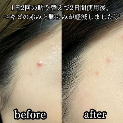 SPOT PATCH ロールタイプ/Shupong/にきびパッチを使ったクチコミ(5枚目)