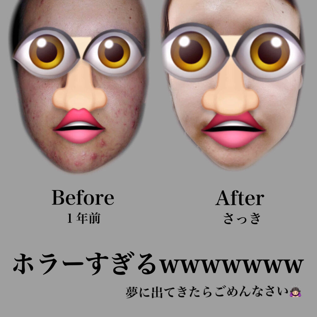 ニキビ治療薬クリーム (医薬品)/クレアラシル/その他を使ったクチコミ（3枚目）