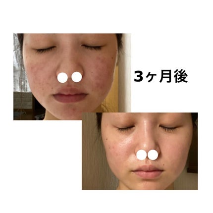 パーフェクトホイップn/SENKA(専科)/洗顔フォームを使ったクチコミ(1枚目)