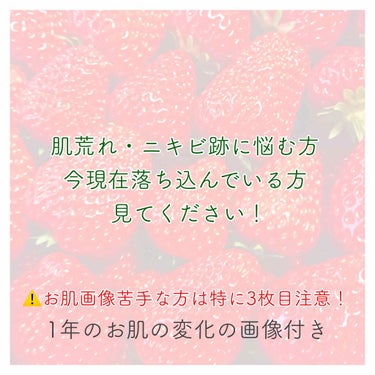 innisfree ビジャ シカバーム EXのクチコミ「現在ニキビ、ニキビ跡に悩むそこの乙女…これを見て元気を出すんだ…!!!

#スキンケア #肌荒.....」（1枚目）