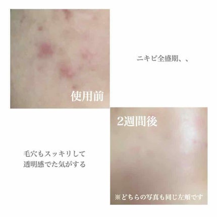 ロゼット洗顔パスタ アクネクリア/ロゼット/洗顔フォームを使ったクチコミ(2枚目)