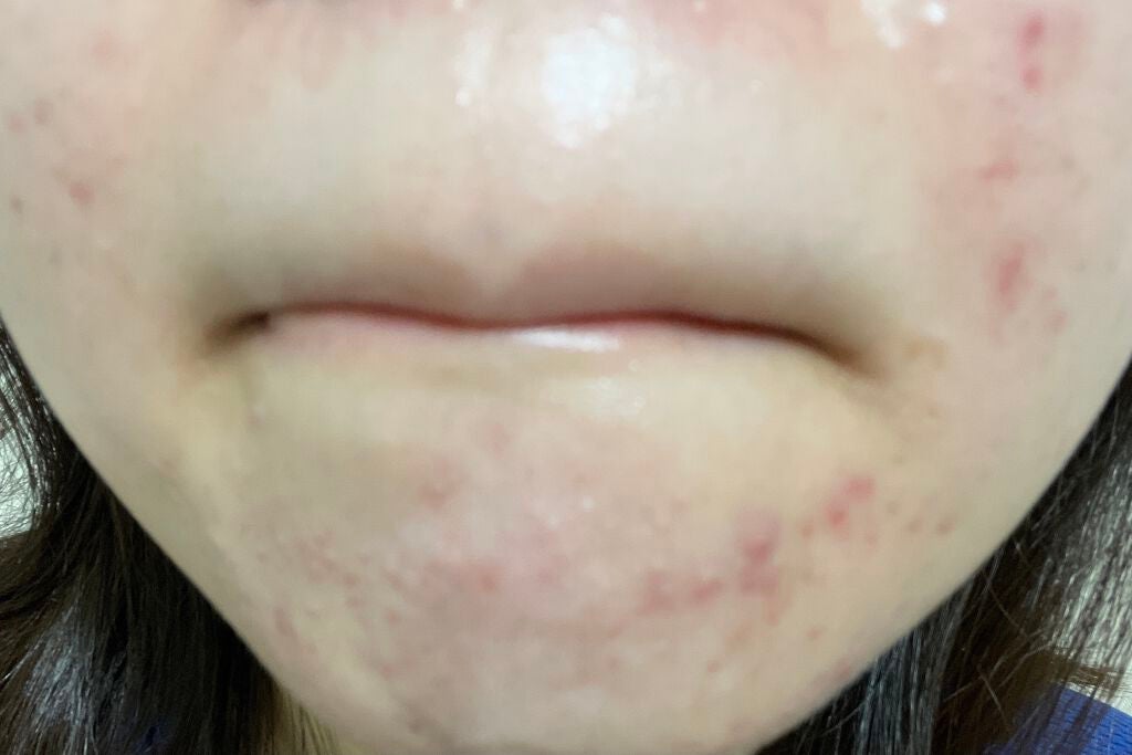まままこ on LIPS 「ニキビゼロ肌を目指して 8月9日⚠️2枚目から肌画像ありスキン..」(4枚目)