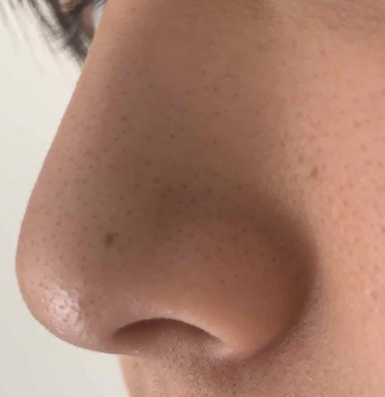 莉 on LIPS 「汚い毛穴ごめんなさい💦💦小鼻の黒ずみが気になり出して色々な方の..」(3枚目)
