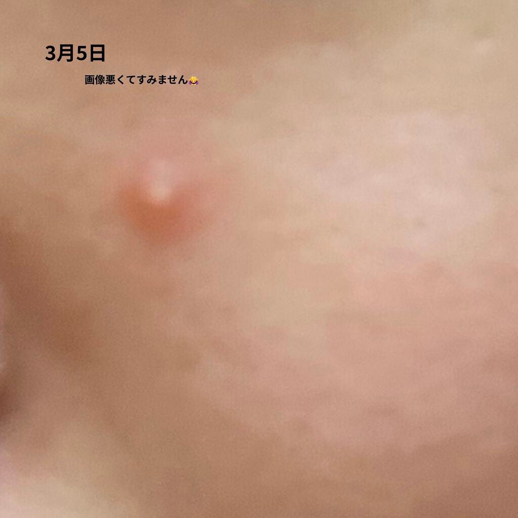 ペアアクネクリームW(医薬品)/ペア/その他を使ったクチコミ(3枚目)