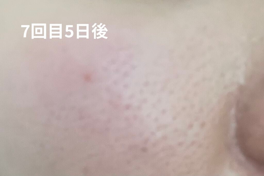 レチノールA 1% アドバンスドリバイタリゼーションクリーム/Life-flo/フェイスクリームを使ったクチコミ(8枚目)