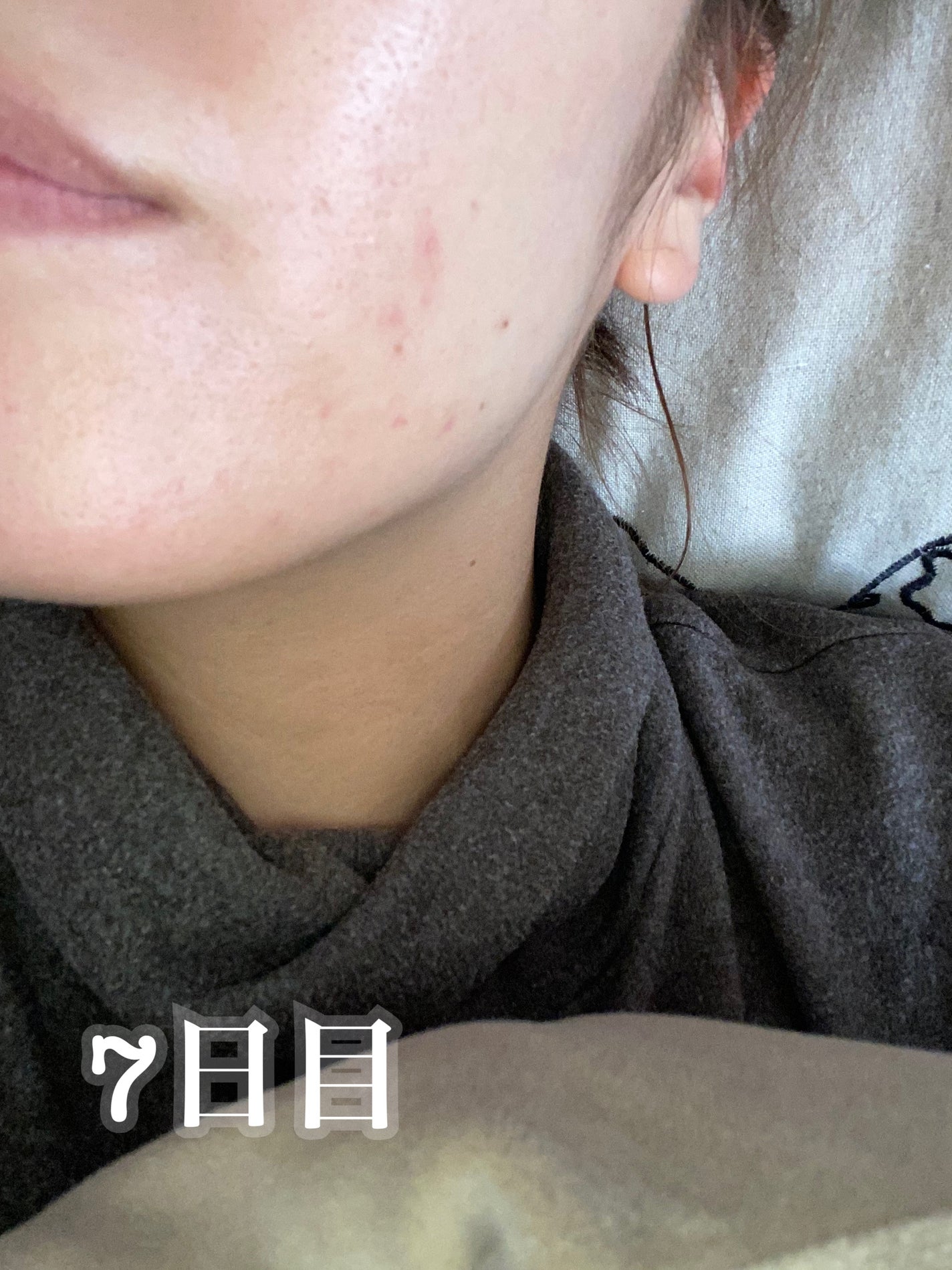 ペアアクネクリームW(医薬品)/ペア/その他を使ったクチコミ(7枚目)