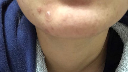 いずみ on LIPS 「どうか助けてください…🥺🙏ニキビとニキビ跡が酷くて、毎日鏡を見..」(4枚目)