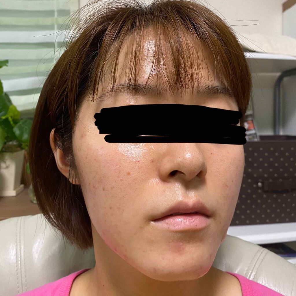 pink_beauty_a6u on LIPS 「下からとったからめちゃ顎でてるけど(笑)昨日皮膚科でニキビ潰し..」(3枚目)