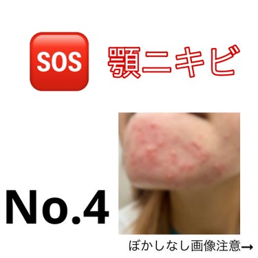 10/11
○本日の体調など

特に普段と変わりなし

新しいニキビがまた増えた…
毛穴が詰まりやすいんだろうな