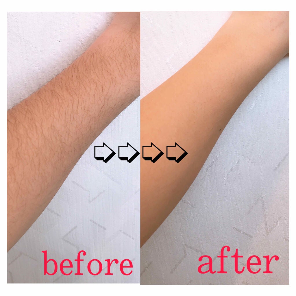 除毛クリームキット スピーディー/エピラット/除毛クリームを使ったクチコミ(3枚目)