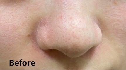 ウォーターピーリング超音波美顔器/ANLAN/美顔器・マッサージを使ったクチコミ(2枚目)