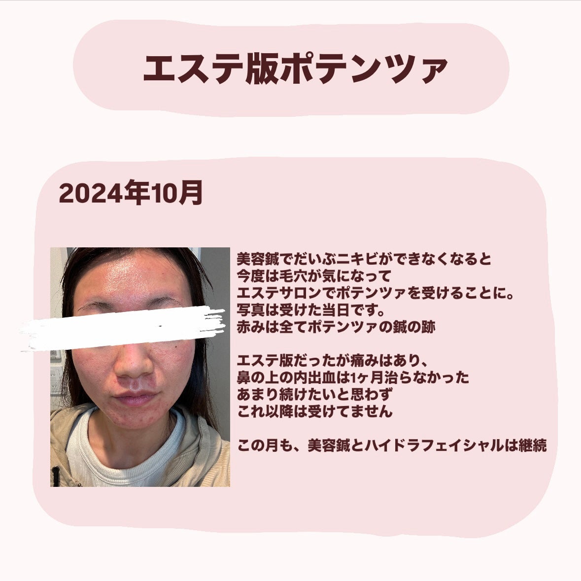 お芋ちゃん|10年以上ニキビに悩む保育士 on LIPS 「2024年7月から、エステサロンで受けた美容施術です。★ハイド..」(4枚目)