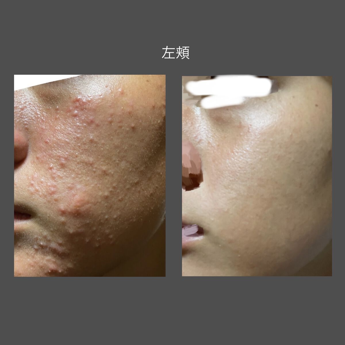 DHC ビタミンＣハードカプセル/DHC/美容サプリメントを使ったクチコミ（2枚目）