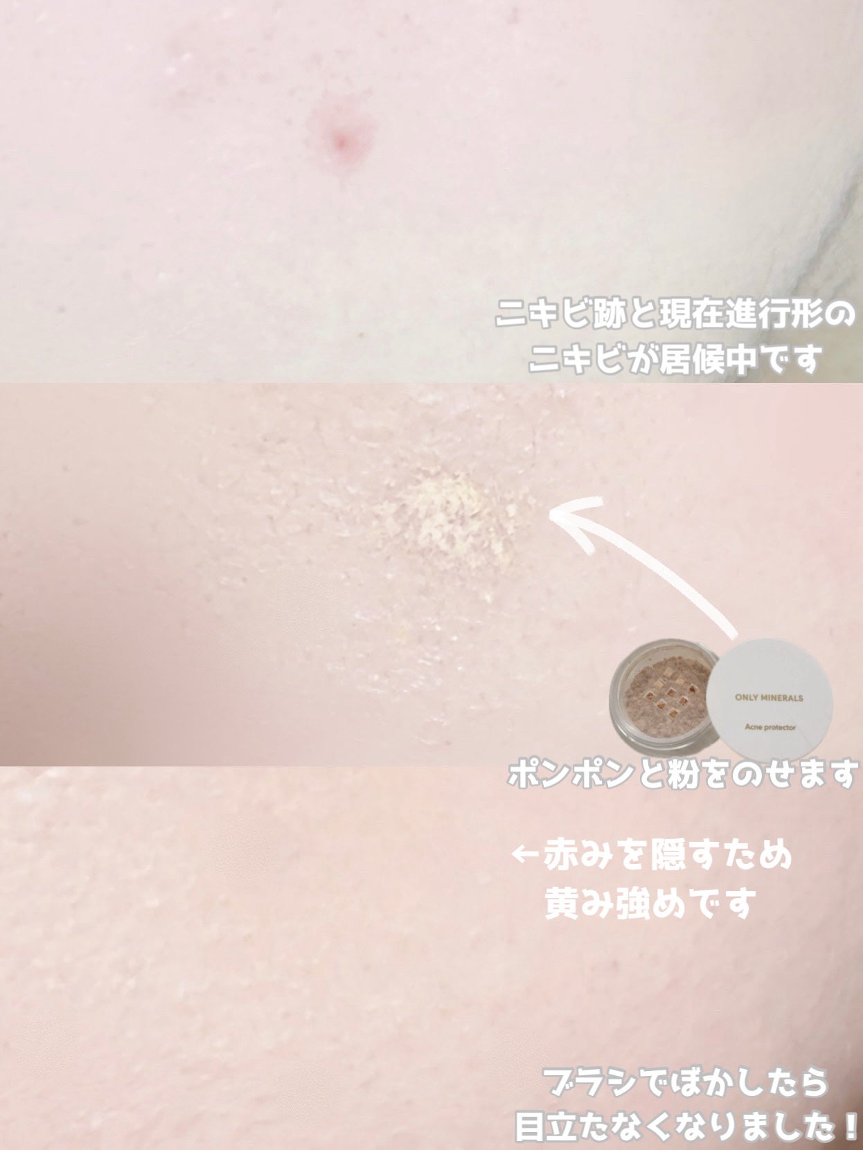 薬用コンシーラー アクネプロテクター/ONLY MINERALS/パウダーコンシーラーを使ったクチコミ(4枚目)