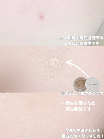 薬用コンシーラー アクネプロテクター/ONLY MINERALS/パウダーコンシーラーを使ったクチコミ(4枚目)