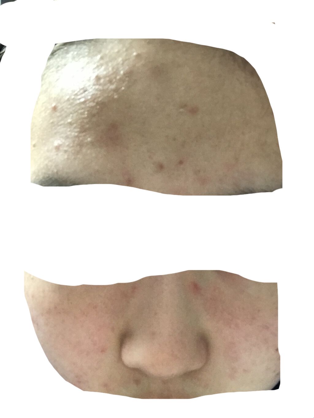 ベトネベートN軟膏AS(医薬品)/第一三共ヘルスケア/その他を使ったクチコミ（2枚目）