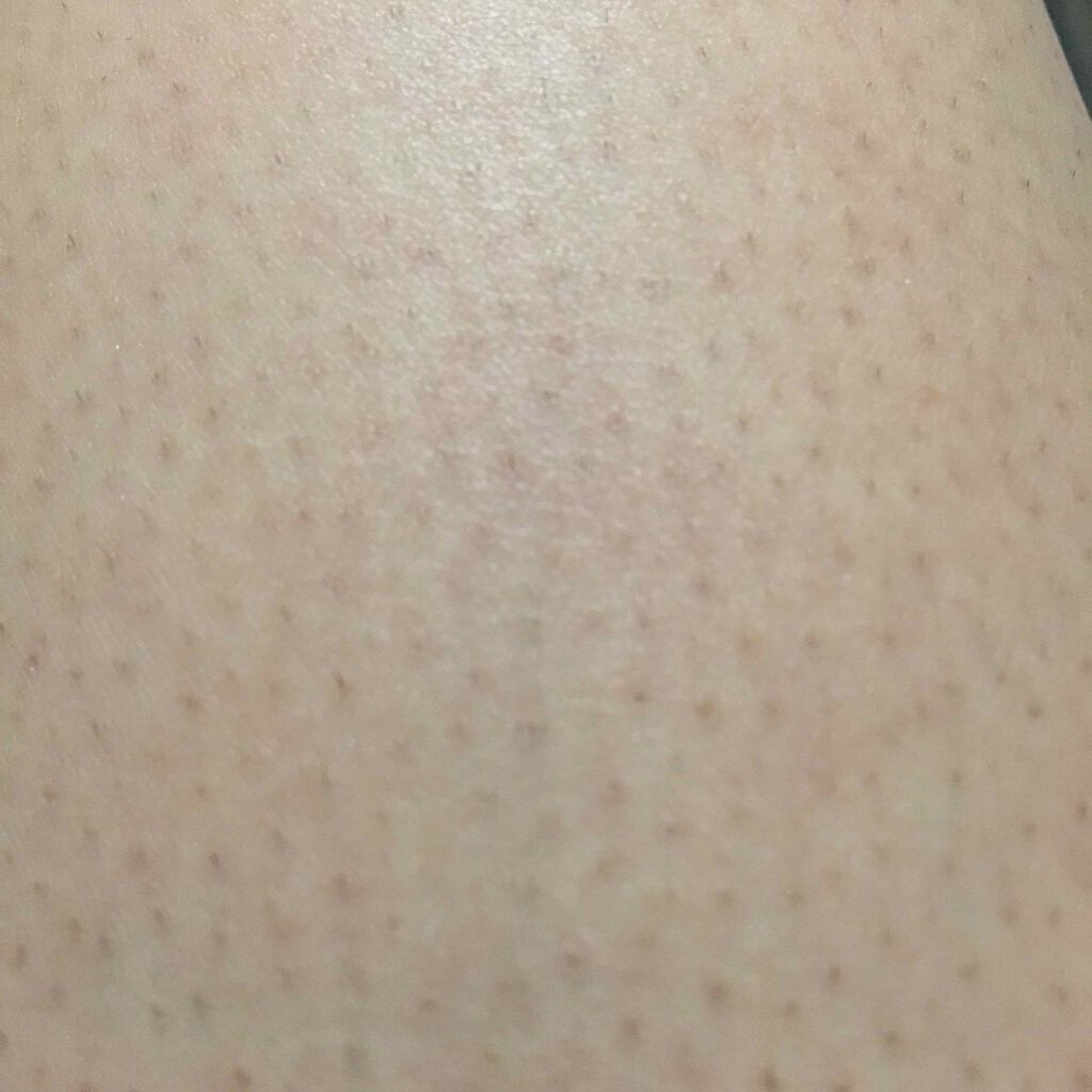 セイナ㌨1940* on LIPS 「はい。写真見てもらったらわかるように、私の足毛穴すごいんです。..」(2枚目)