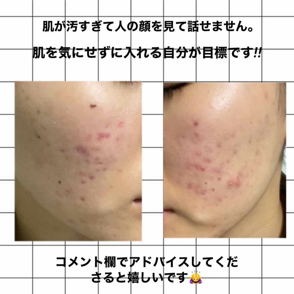 ララ on LIPS 「助けてください‼︎今高校生1年生です。4、5年前からニキビがで..」(2枚目)