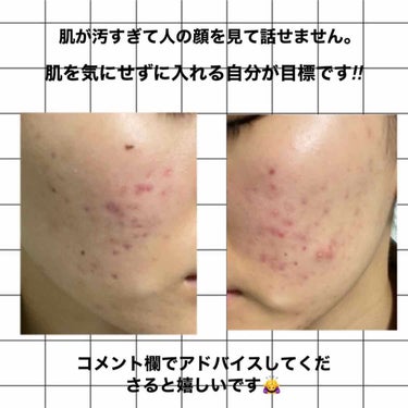 ララ on LIPS 「助けてください‼︎今高校生1年生です。4、5年前からニキビがで..」（2枚目）