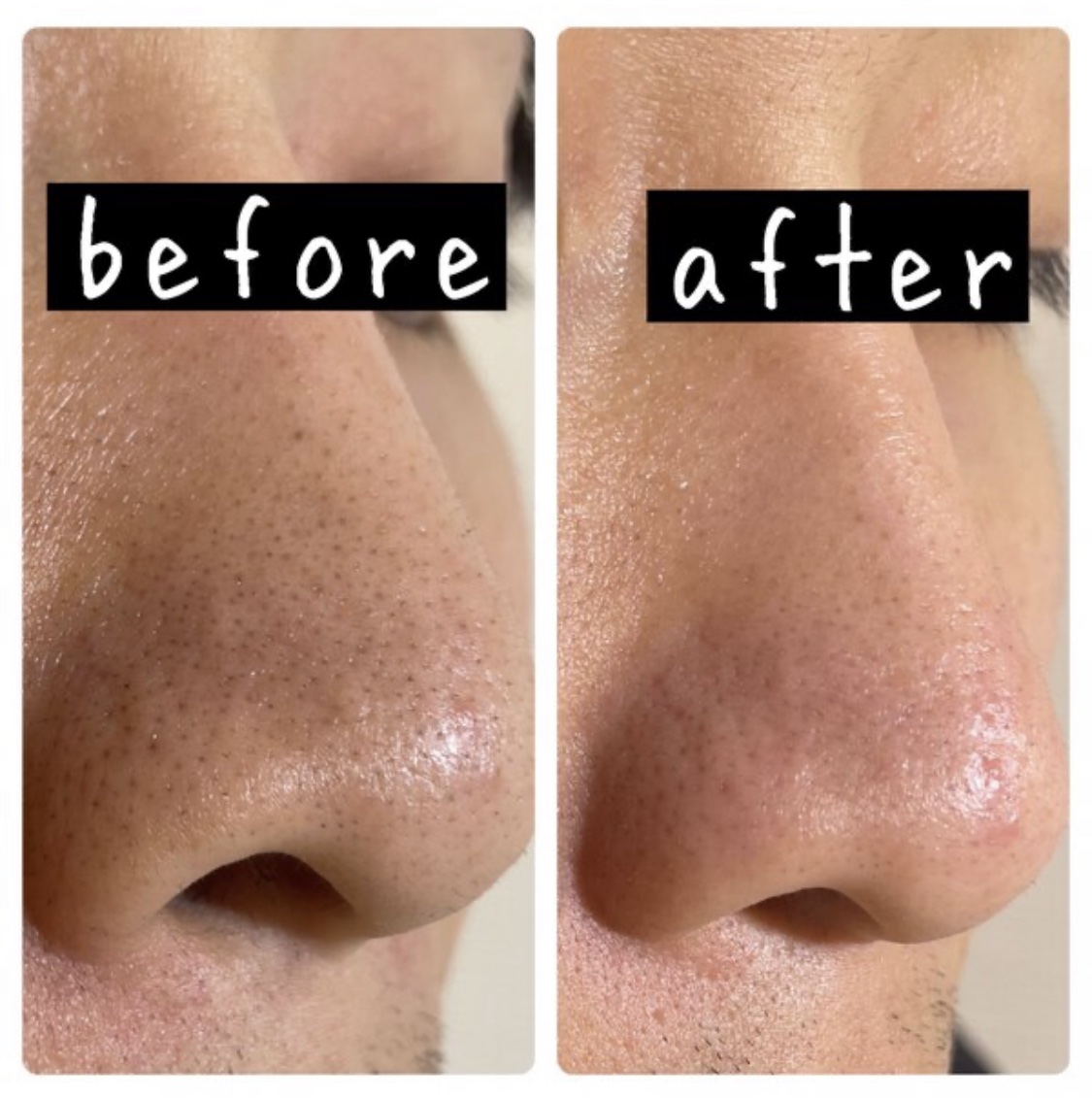 ウォーターピーリング超音波美顔器/ANLAN/美顔器・マッサージを使ったクチコミ（2枚目）