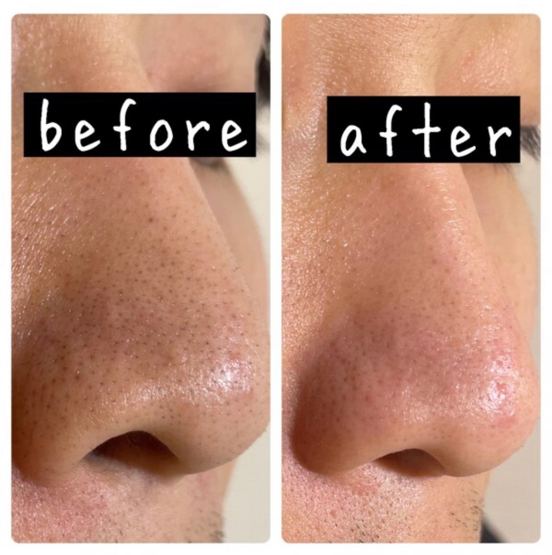 ウォーターピーリング超音波美顔器/ANLAN/美顔器・マッサージを使ったクチコミ(2枚目)