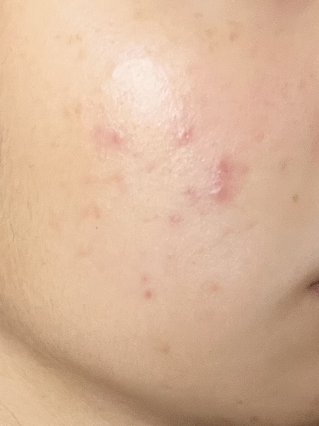 A アクネフォーム/NOV/洗顔フォームを使ったクチコミ（1枚目）