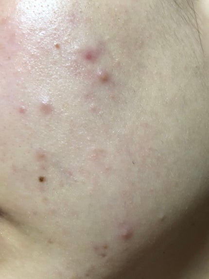 ちー on LIPS 「またニキビができてきました。。いい皮膚科とも出会えず…。この赤..」(4枚目)