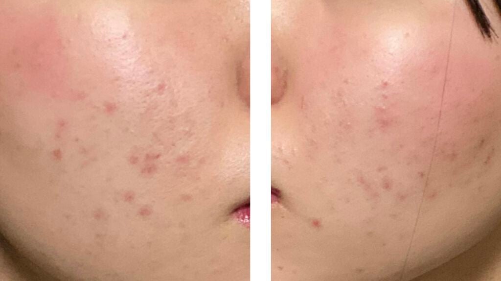 薬用しみ対策 美白化粧水/メラノCC/化粧水を使ったクチコミ(3枚目)