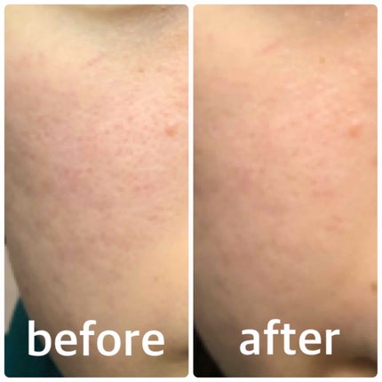 ティーツリーケアソリューション アンプルマスクJEX/MEDIHEAL/シートマスク・パックを使ったクチコミ(2枚目)