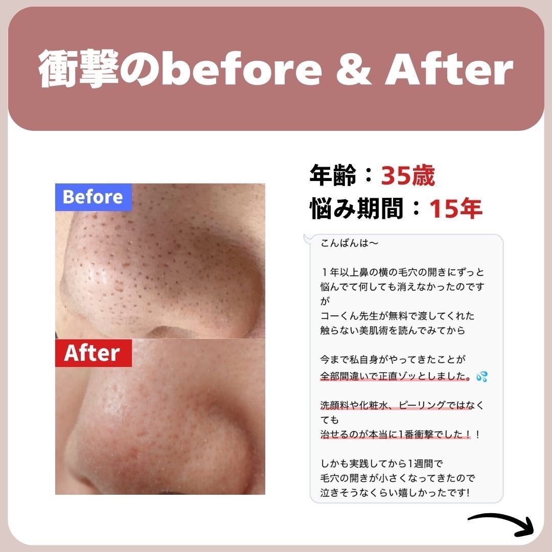 あなたの肌に合ったスキンケア💐コーくん先生 on LIPS 「【9割が知らない】鼻の黒ずみがゴッソリ消える裏技🤫..あなたの..」(2枚目)