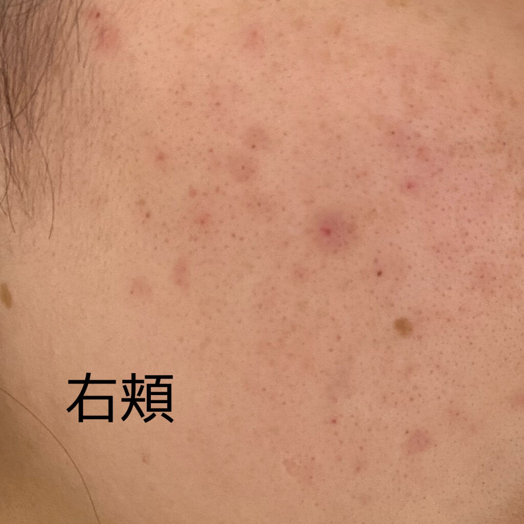 薬用クリーム洗顔/メンソレータム アクネス/洗顔フォームを使ったクチコミ（2枚目）