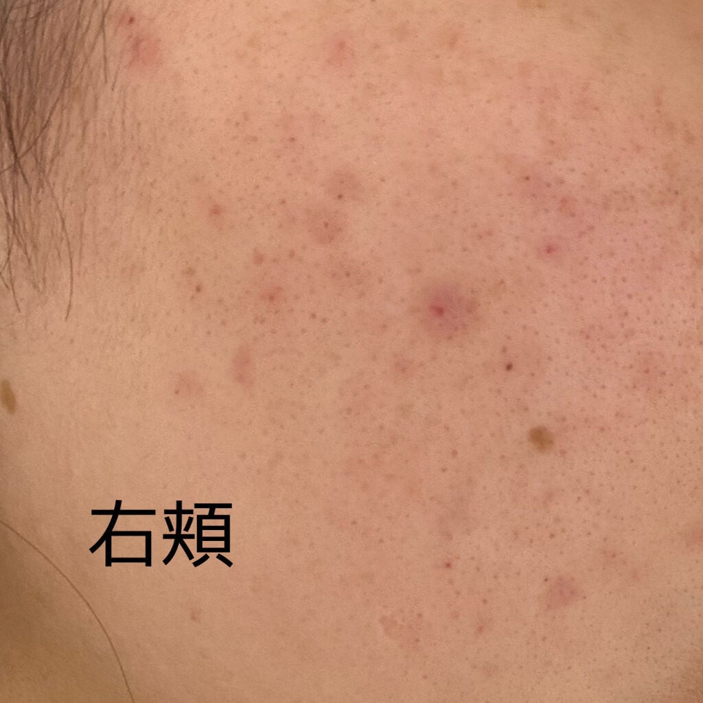 薬用クリーム洗顔/メンソレータム アクネス/洗顔フォームを使ったクチコミ(2枚目)