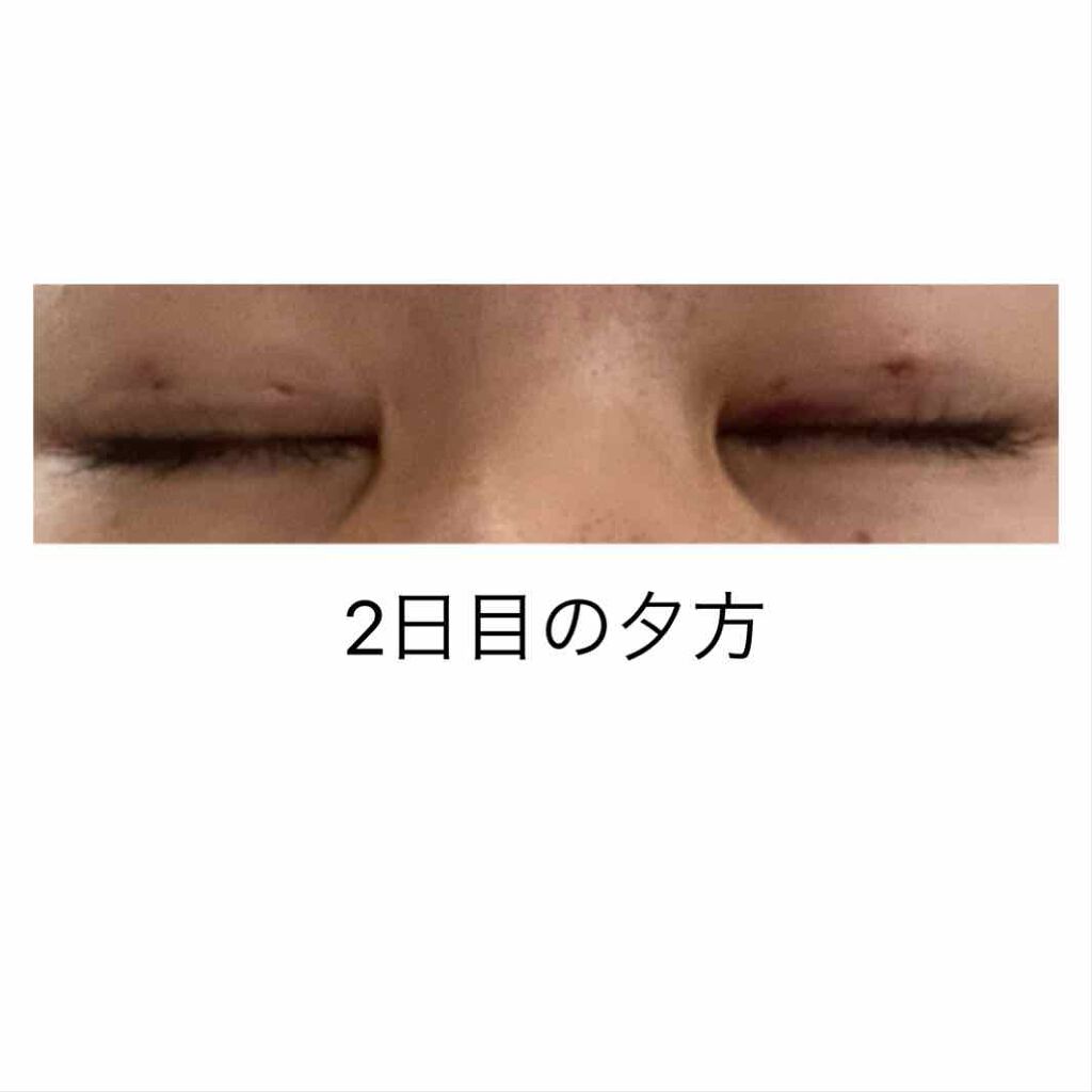 かっこいい女になりたいんだ on LIPS 「2日目の夕方朝と比べるとほんの少し腫れは引いた様子です今日は一..」(2枚目)