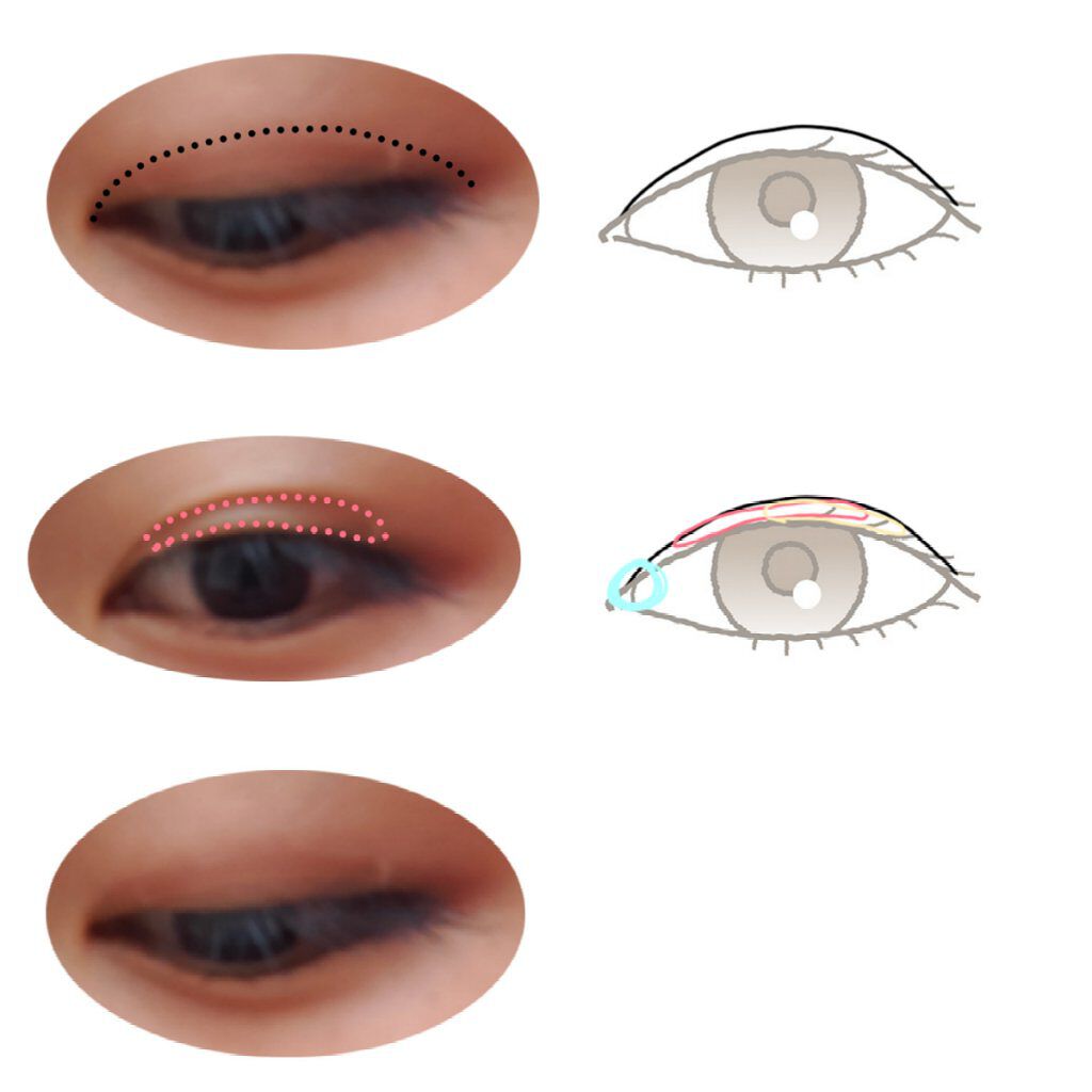 のびーるアイテープ(絆創膏タイプ、レギュラー)/DAISO/二重まぶた用アイテムを使ったクチコミ(3枚目)