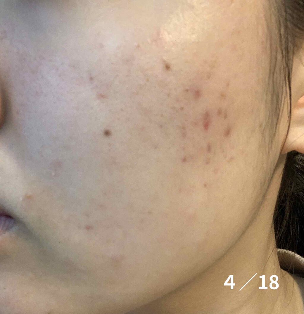 薬用 しみ 集中対策 美容液/メラノCC/美容液を使ったクチコミ(4枚目)
