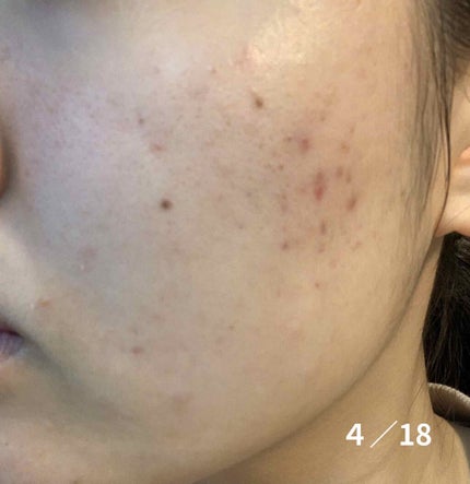 薬用 しみ 集中対策 美容液/メラノCC/美容液を使ったクチコミ(4枚目)