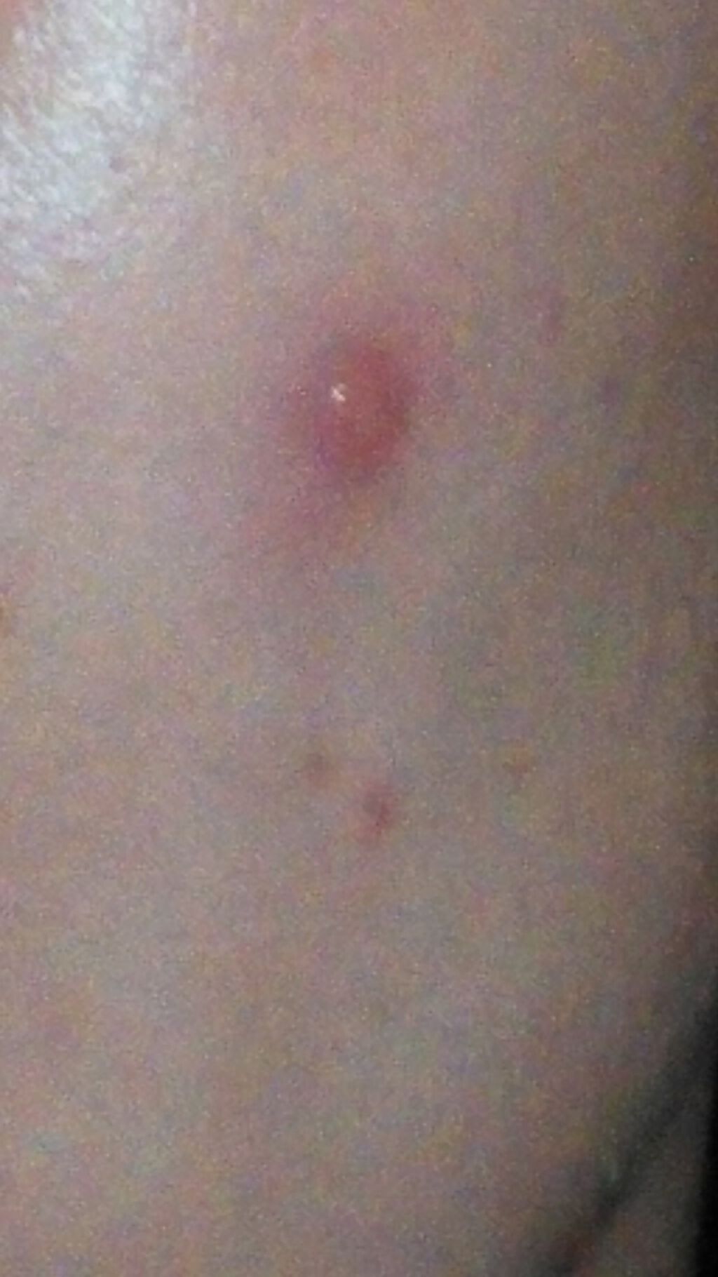 ゼロスポットパッチ/Today’s Cosme/にきびパッチを使ったクチコミ（3枚目）