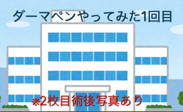 お久しぶりです。
毛穴やニキビ跡にずっと悩んでいた私…
もう隠すのに疲れてしまい、とうとう手を出しました

そう、ダーマペン ！！！

皆さん！ご存知でしょうか？
検索したら色々出てくるんですけど、簡単