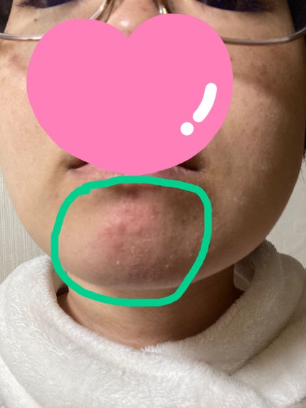 ディフェリンゲル0.1%/ガルデルマ/その他スキンケアを使ったクチコミ(3枚目)