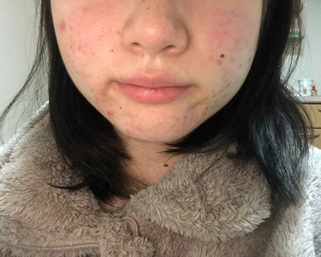 マンスリースキンケアプログラム(旧)/APEX/スキンケアキットを使ったクチコミ（2枚目）