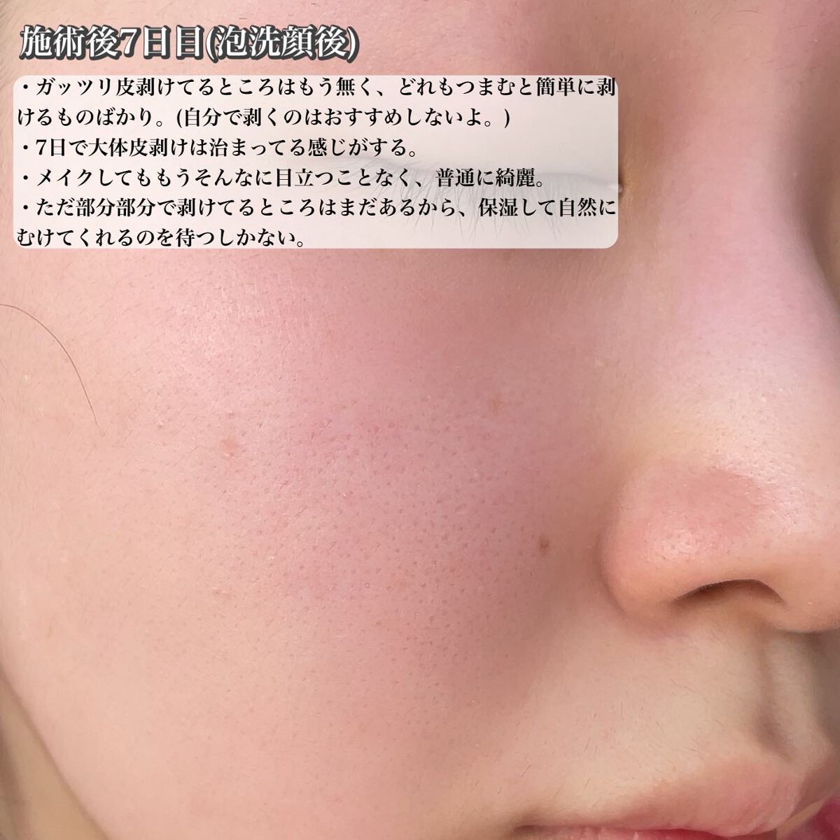 ダーマスキンピーリング/BQCELL/その他キットセットを使ったクチコミ(9枚目)