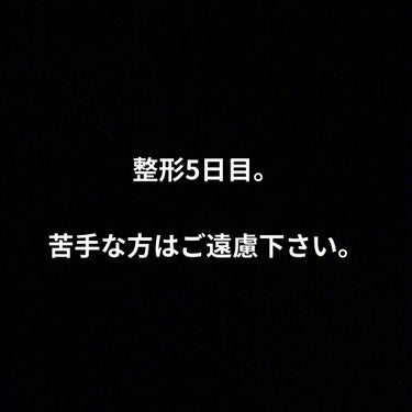 整形5日目。

メイク前とメイク後。

メイク下手くそでした…（笑）

かなり自然に近づいてきてます☆