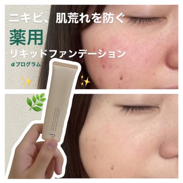 d プログラム 薬用 スキンケアファンデーション（リキッド）のクチコミ「負担感のないファンデ🌿

ニキビや肌荒れが酷いけど、
どうしてもファンデーションを
付けないと.....」（1枚目）