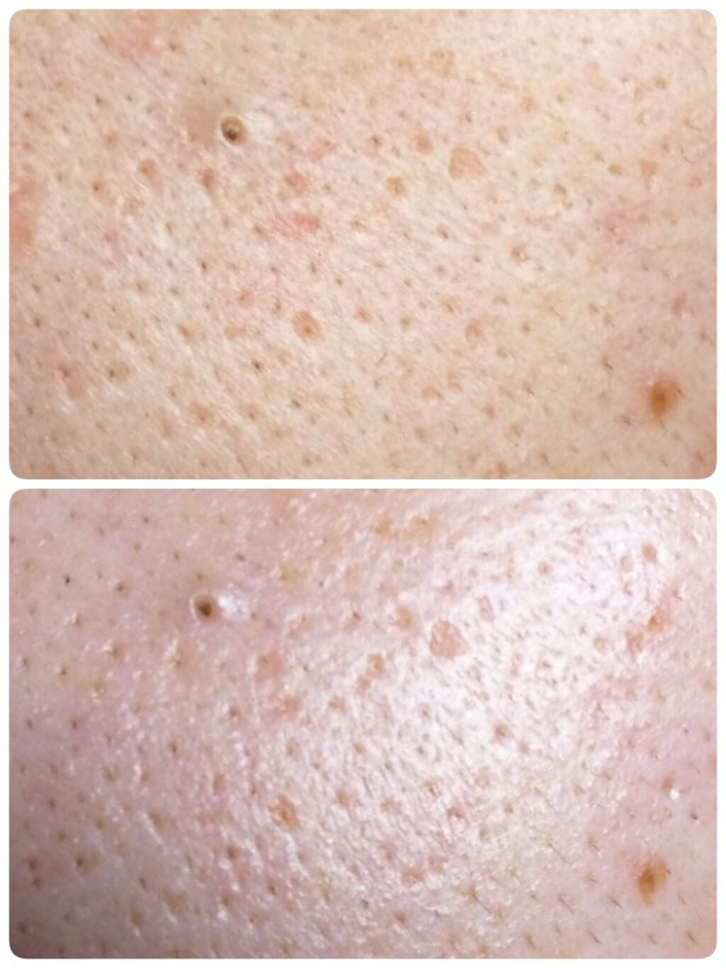 ウィッチヘーゼルエキス(ハマメリス葉エキス)/TUNEMAKERS/美容液を使ったクチコミ(4枚目)