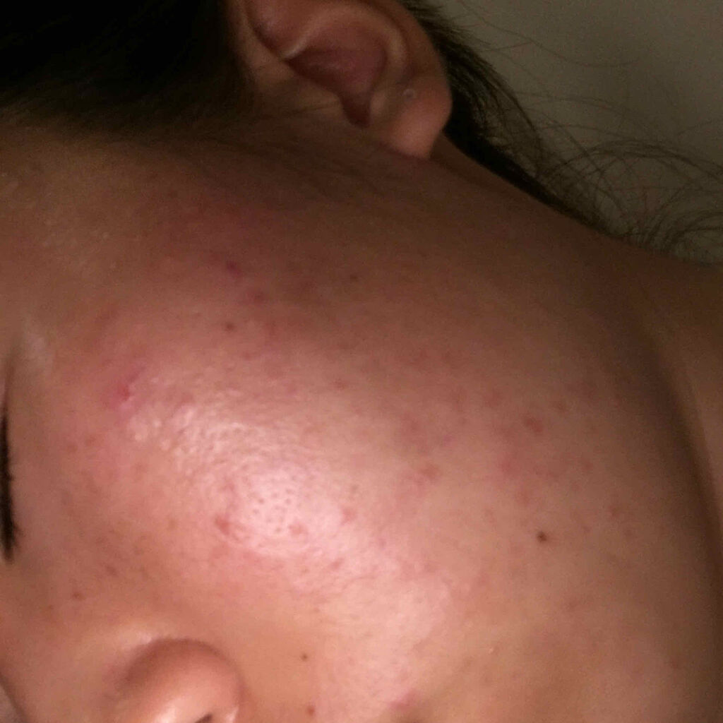 ベピオゲル/マルホ株式会社/その他を使ったクチコミ（1枚目）